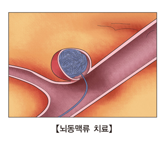  뇌 동맥류 치료 그림 예시