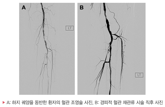 A: 하지 궤양을 동반한 환자의 혈관 조영술 사진. B: 경피적 혈관 재관류 시술 직후 사진