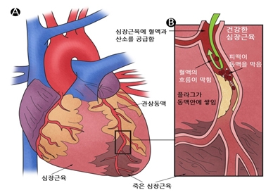 관상동맥질환이란