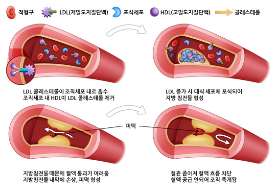 관상동맥 질환의 진행