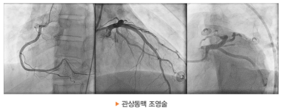 관상동맥 조영술