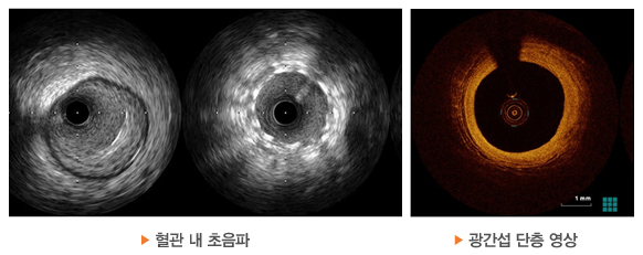혈관 내 초음파 / 광간섭 단층 영상