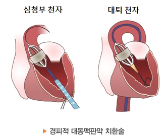 경피적 대동맥 판막 치환술