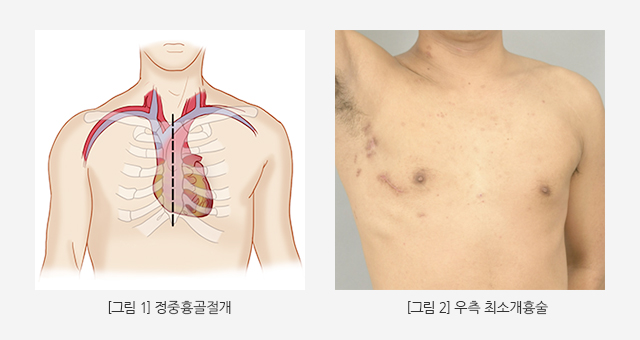 정중흉골절개 / 우측 최소개흉술