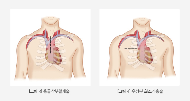 흉골상부절개술 / 우상부 최소개흉술