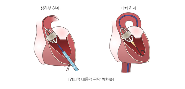 베타 차단제 (Beta Blocker)