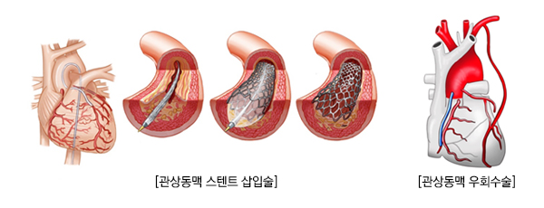 관상동맥 스텐트 삽입술 / 관상동맥 우회수술