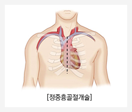 정중흉골절개술