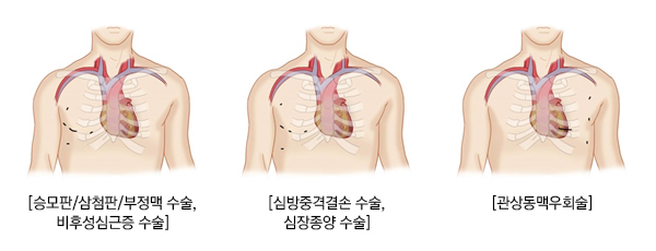 이솝을 이용한 우측개흉술