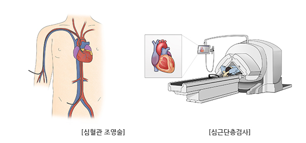 관상동맥질환