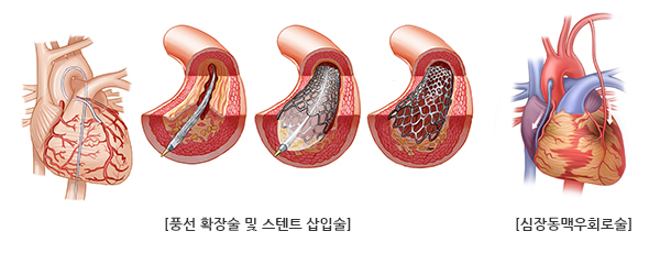 관상동맥질환