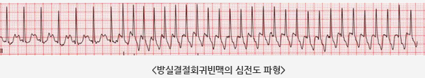 방실결절회귀빈맥의 심전도 파형