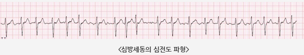 심방세동의 심전도 파형