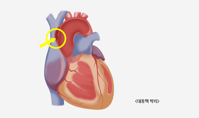 그림 2. 한국 2형 당뇨병에서 심혈관 질환의 유병률 / (출처: Diabetes Fact Sheet in Korea 2015, 대한당뇨병학회)
