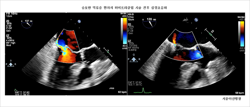 중증 승모판 역류증 환자의 마이트라클립 시술 전 초음파 사진(좌) 및 시술 후 초음파 사진(우). 왼쪽사진에서 승모판막이 제대로 닫히지 않아 보이는 중증 승모판 폐쇄부전에 의한 혈액 역류 현상이 마이트라클립 시술 후 찍은 초음파 사진에서는 경도로 약해진 것을 보여주고 있다.