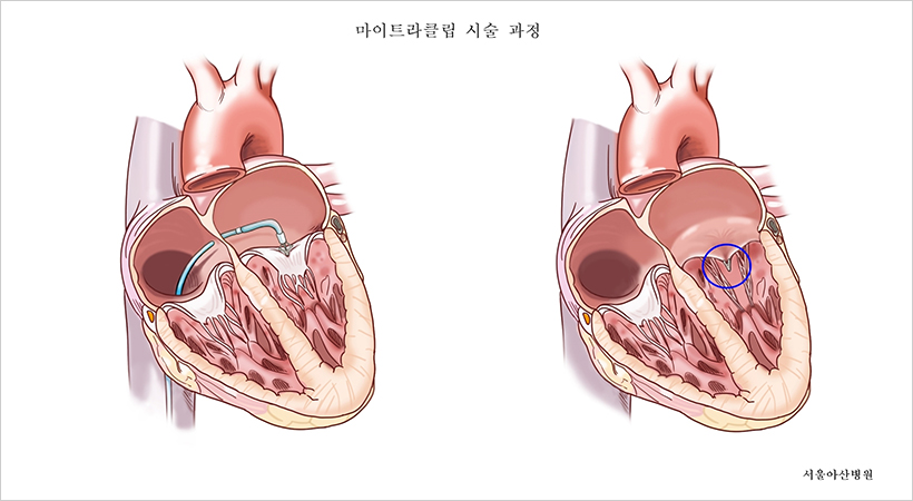 마이트라클립 시술 모식도. 사타구니 혈관을 통해 가느다란 관을 넣어 심장 내부에 도달한 뒤(왼쪽 사진), 승모판막을 구성하는 두 개의 판 사이에 클립을 장착해(오른쪽 사진) 판막이 닫힐 때 생기는 빈틈을 줄여 혈액 역류를 감소시킨다.