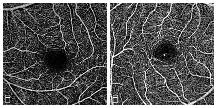 좌측은 근시안, 우측은 정상안의 황반부 망막혈관 사진으로 중심부 무혈관 부위가 좌측(근시안)에서 더 크고 주변부 혈관망의 혈관밀도가 더 적은 것을 확인할 수 있다.