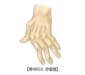 류마티스 관전염으로 인해 손가락이 휘어있는 사진 예시