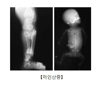 저인산증이 발병된 신생아의 전신및 다리 X-ray 사진 예시