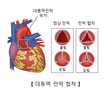 대동맥 판막 위치 및 정상판막 과 판막협착의 열림 및 닫힘상태의 예시