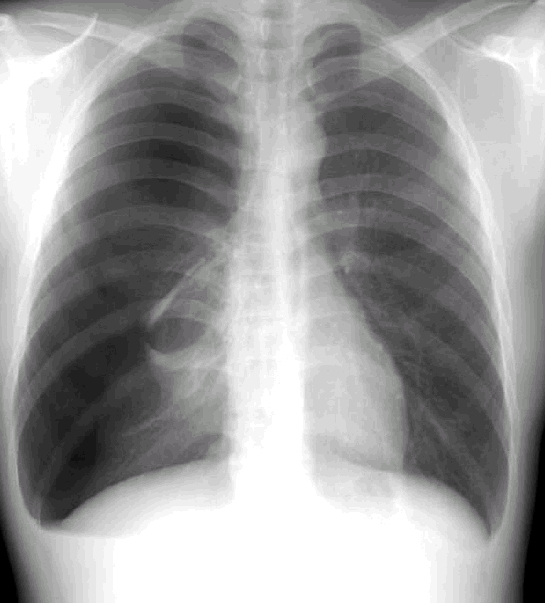 가슴 x-ray 이미지