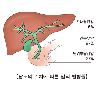 간내담관암 6% 간문부암 67% 원위부담관암 27% 담도 위치에 따른 암 발병률 예시