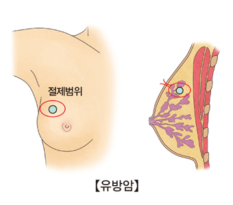 유방암의 절제범위와 측면에서 바라본 절제범위 위치의 예시