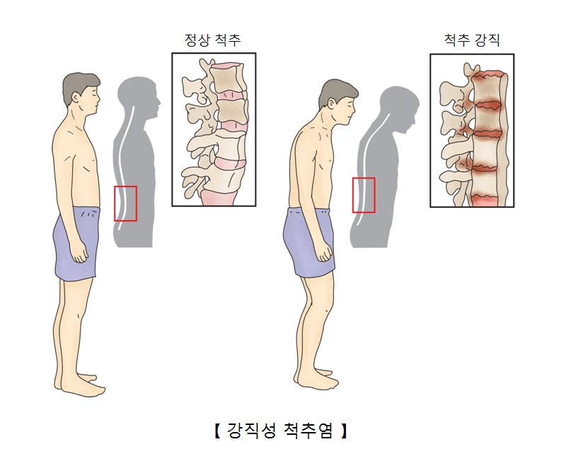 정상인의 척추와 강직성척추염에 걸인 사람의 척수 사진 예시