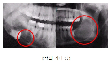 턱주변 기타낭을 찍은 x-ray사진