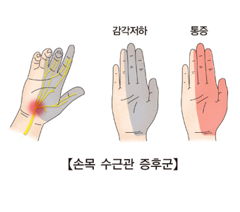 손목 수근관 증후군 사진 예시(감각저하,통증)