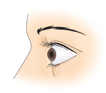 갑상선 중독증으로 눈이 돌출된 여성의 예시