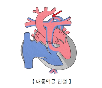 대동맥궁 단절의 예시