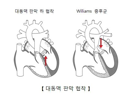 대동맥 판막 하 협착 과 Williams증후군등 대동맥 판막 협착의 예시