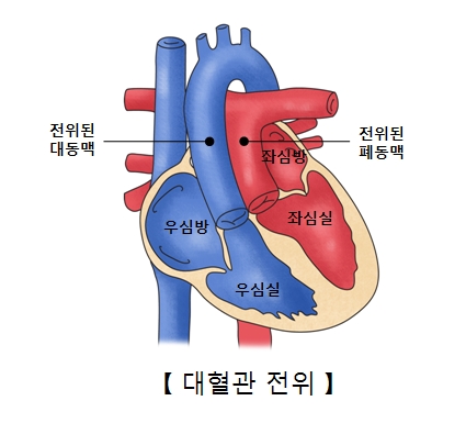 좌심방 좌심실 전위된 폐동맥 우심방 우심실 전위된 대동맥의 위치및 대혈관 전위의 예시