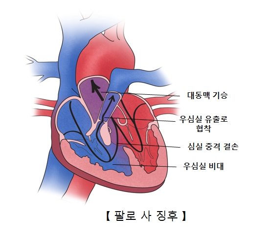 대동맥 기승 우심실 유출로 협착 심실 중격 결손 우심실 비대의 진행 방향및 팔로 사 징후의 예시