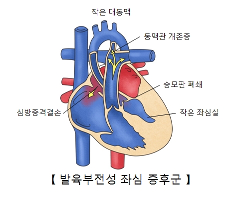 작은대동맥 동맥관 개존증 승포판 폐쇄 작은 좌심실 심방중격결손의 위치와 발육부전설 좌심 증후군의 예시