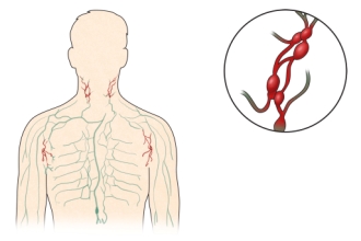 우리몸 혈관및 혈관에 분포된 림프구증가증의 예시