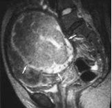 MRI찰영을 한 자궁의 평활근종 예시