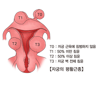 T0 자궁 근육에 침범하지 않음 T1 50% 미만 침윤 T2 50% 이상 침윤 T3 자궁 전체 침윤 등 자궁의 평활근종의 차이점 예시