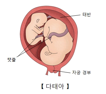 다태아-자궁안에 2명의 태아가 있는 그림 예시및 태반,탯줄,자궁경부의 위치
