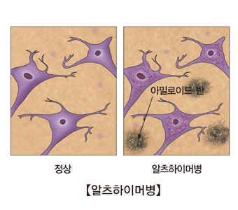 알츠하이머병-정상세포와 알츠하이머병에걸린 세포의 모습 예시