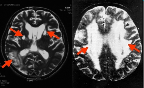 치매에 걸린사람의 뇌자기공명영상의 사진 예시 