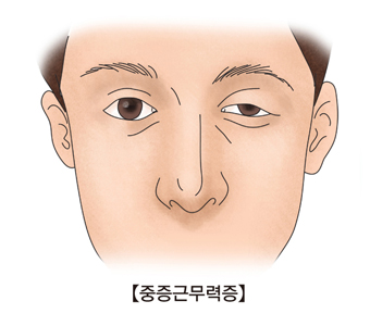 중증근무력증-왼쪽눈이 부어오른 남성