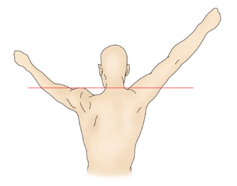 부종이있는 왼쪽어깨는 들어올리지 못하고 정상인 오른쪽어깨는 똑바로 들고있는 모습