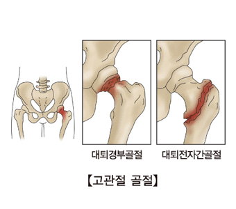 고관절 골절과 대퇴경부골절 대퇴전자간골전 사진 예시