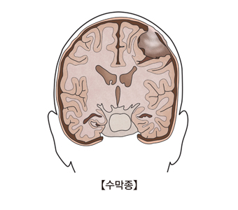 수막종-수막정에 걸린 뇌의 단면도 그림 예시