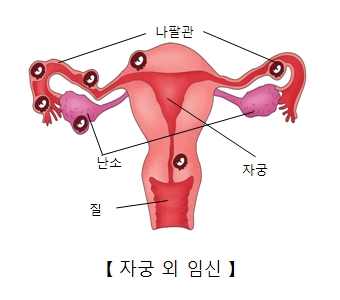 자궁 외 임심- 질,난소,자궁,나팔괸의 위치와 자궁외 임신할수 있는 위치