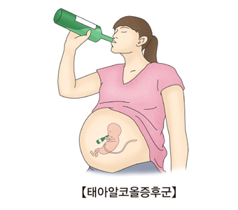 임신한 여성이 술을 마시고 있음(뱃속의 태아도 같이 술을마시고있음)