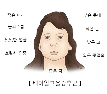 태아알코올증후군-작은머리,몽고주름,밋밋한얼굴,흐릿한인증,좁은턱,낮은콧대,작은눈,낮은코,얇은윗입술