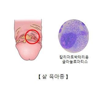 남성의성기에생긴 염증과 칼리마토박테리움 글라눌로마티스 세균